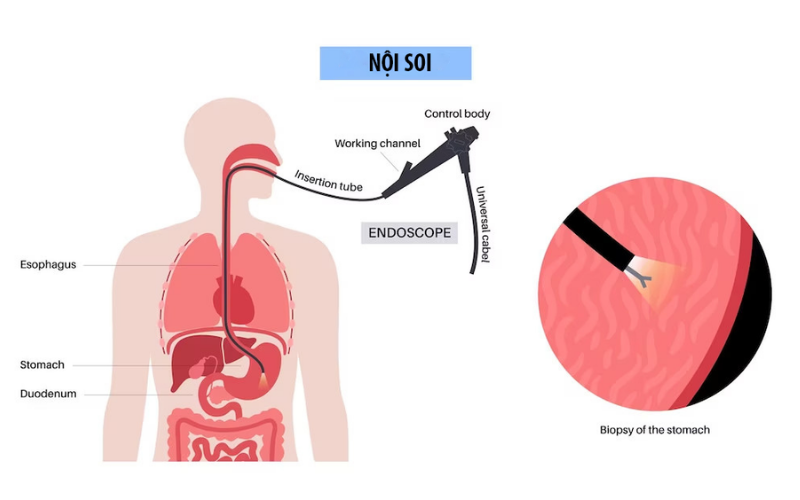 khi nào cần nội soi dạ dày